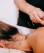 Acupuncture for pinched nerves