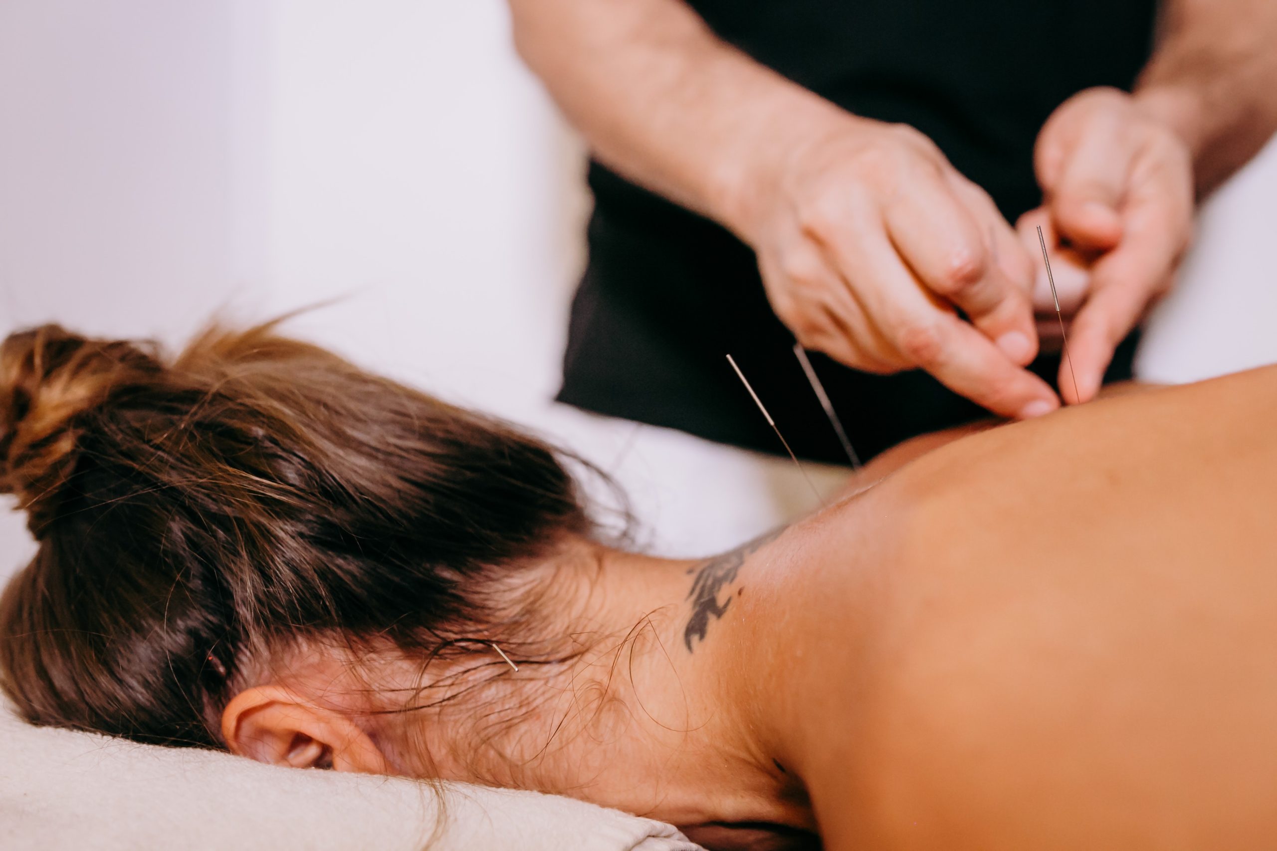 Acupuncture for pinched nerves